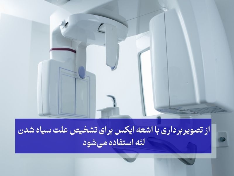 تشخیص سیاه شدن لثه