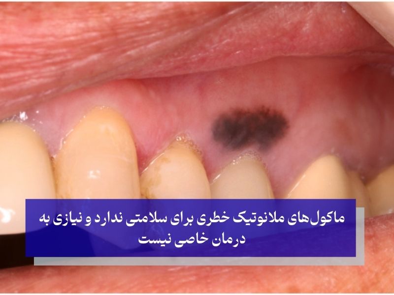 شایع ترین علت سیاه شدن لثه