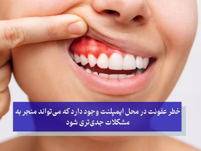 عفونت پس از ایمپلنت DIO