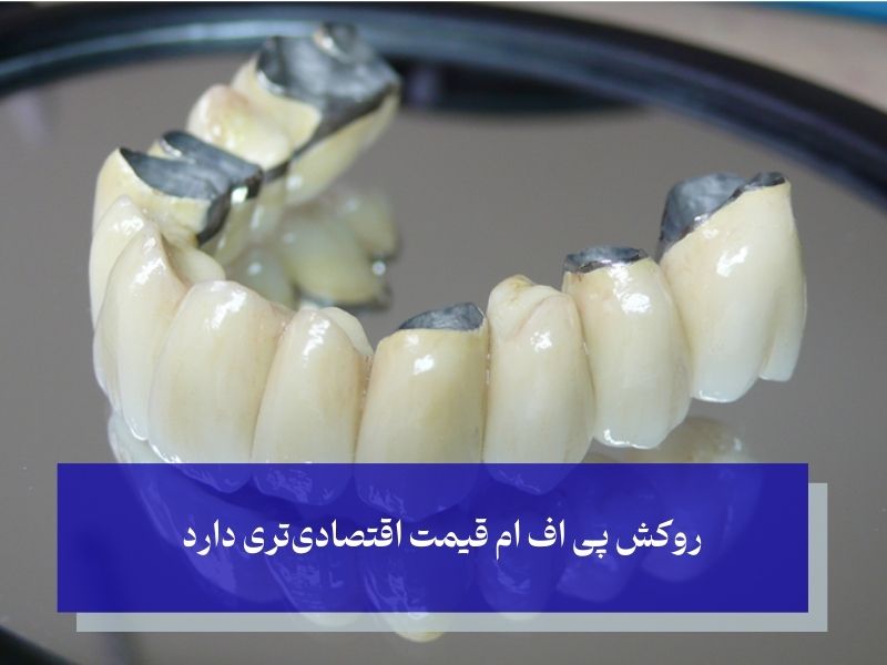 مزایای روکش پی اف ام