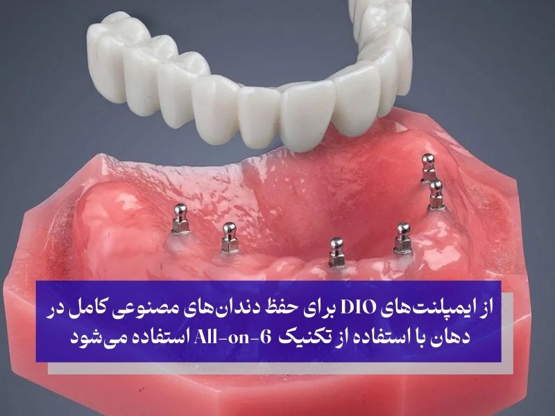 مزایای شگفت‌انگیز ایمپلنت دیو