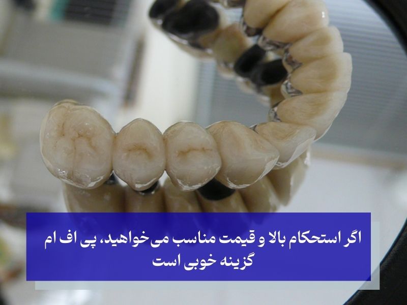 مقایسه روکش پی اف ام با سایر روکش‌های دندان