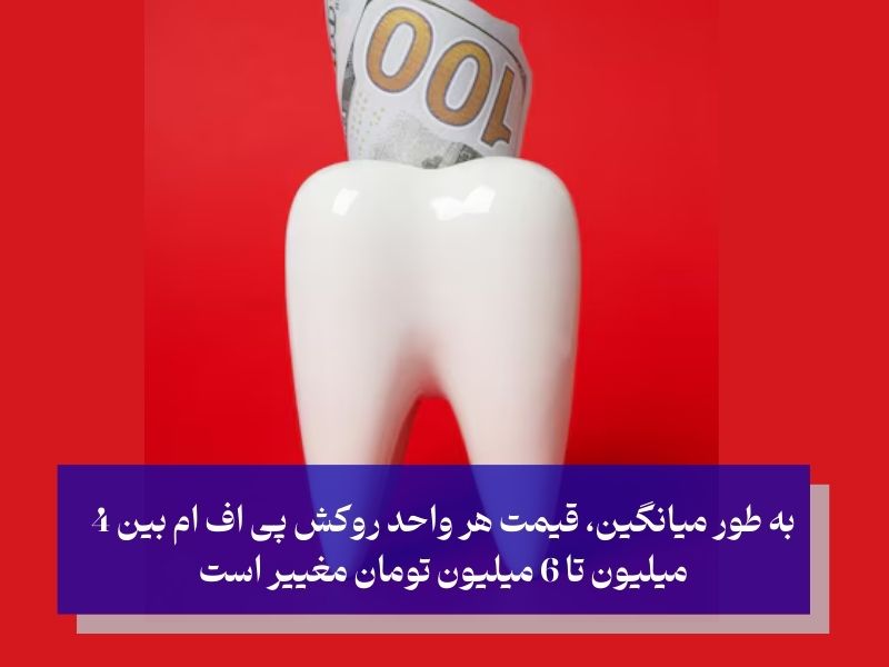 هزینه روکش پی اف ام