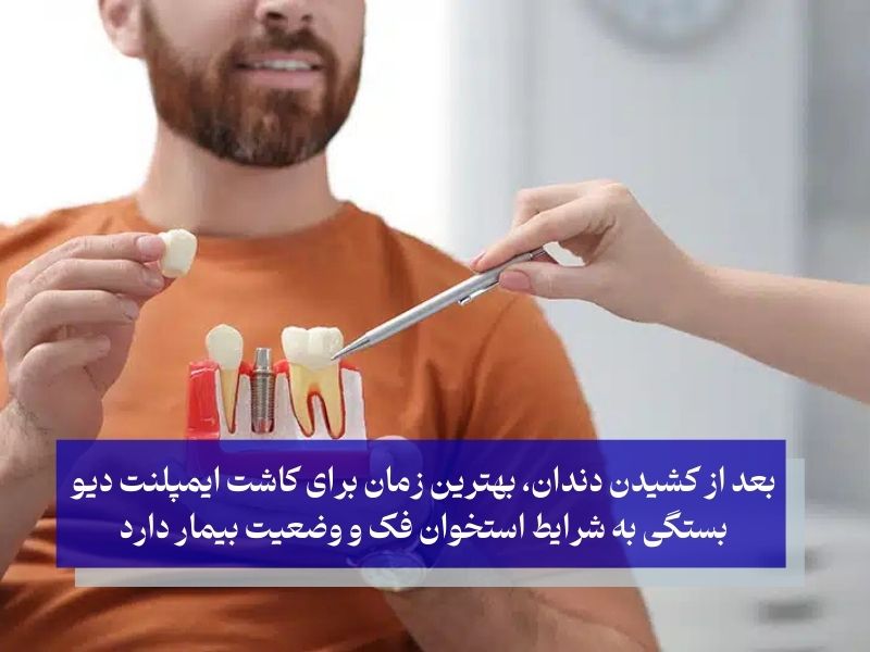 کاشت ایمپلنت دیو