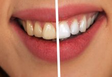 رفع زردی دندان در یک روز