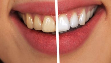 رفع زردی دندان در یک روز