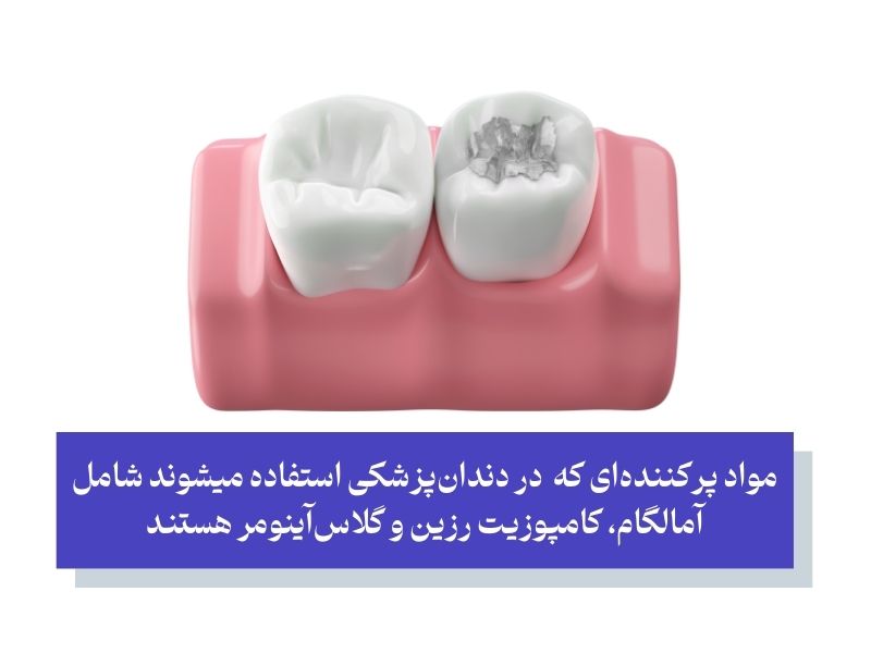 انتخاب مواد پر کردن دندان در بارداری