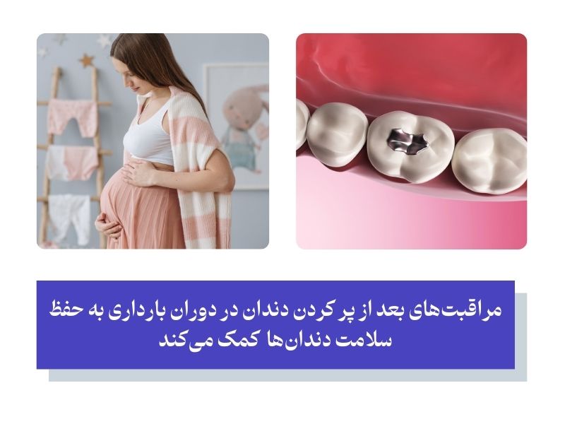 مراقبت‌های ضروری بعد از پر کردن دندان در بارداری