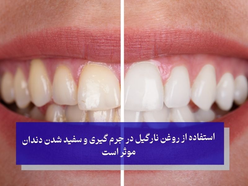استفاده از روغن نارگیل در جرم گیری و سفید شدن دندان موثر است