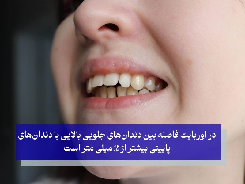 تعریف اوربایت چیست؟