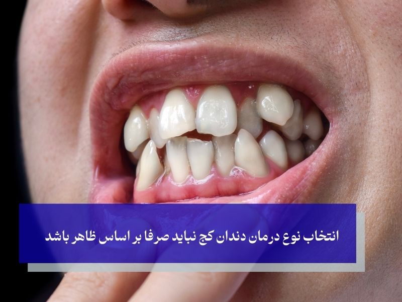 چرا افراد به‌جای ارتودنسی سراغ کامپوزیت برای دندان های کج می‌روند