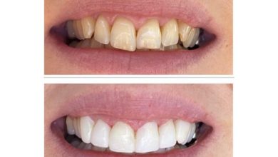 کامپوزیت برای دندان های کج