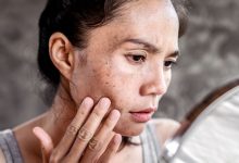 سریع‌ترین راه از بین بردن لک قهوه‌ای صورت