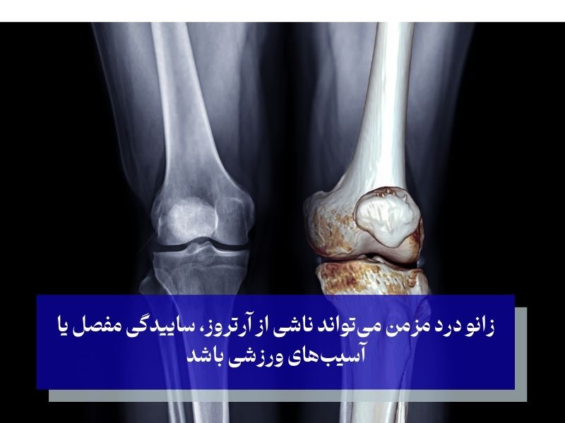 زانو درد مزمن می‌تواند ناشی از آرتروز، ساییدگی مفصل یا آسیب‌های ورزشی باشد