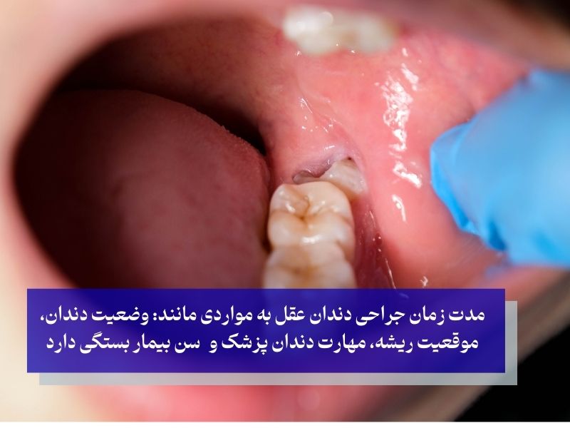 Wisdom tooth surgery duration