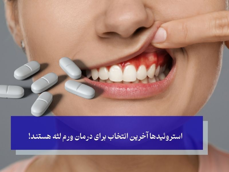 آیا قرص‌های ضدالتهاب استروئیدی برای ورم لثه تجویز می‌شوند؟