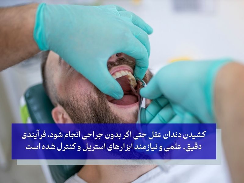 آیا کشیدن دندان عقل بدون جراحی در خانه ممکن است