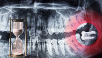 جراحی دندان عقل چقدر طول می‌کشد