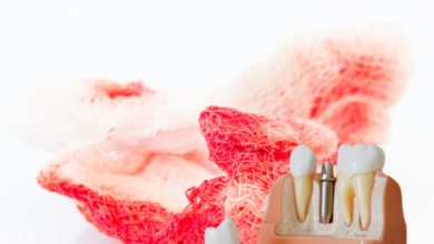 خونریزی بعد از ایمپلنت