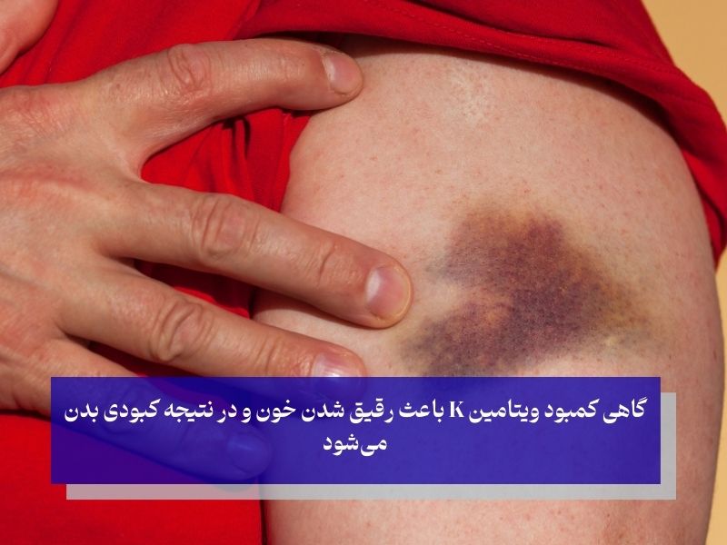 دلایلی که باعث کبودی بدن می‌شوند؛