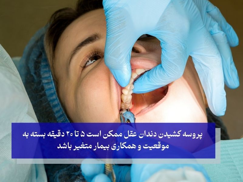 روش انجام کشیدن دندان عقل بدون جراحی چطور است