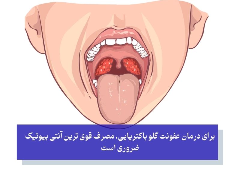 عفونت گلو باکتریایی