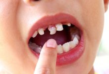 علت دیر افتادن دندان شیری