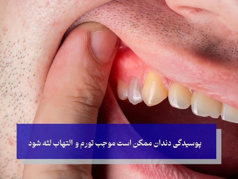 عوارض پوسیدگی دندان