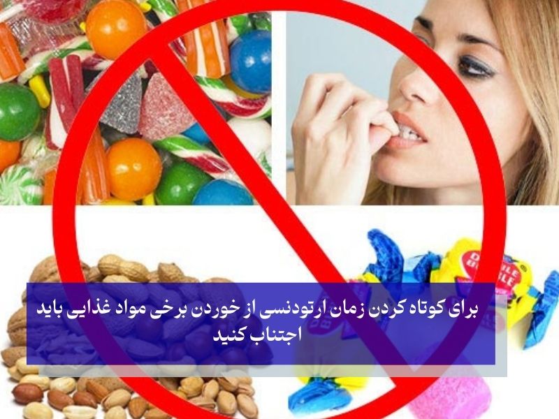 فهرست غذاهای ممنوع برای ارتودنسی
