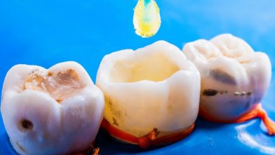 مراحل پر کردن دندان