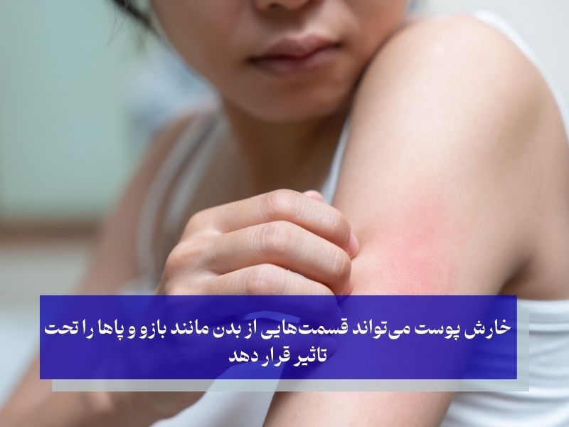 نتایج خارش پوست