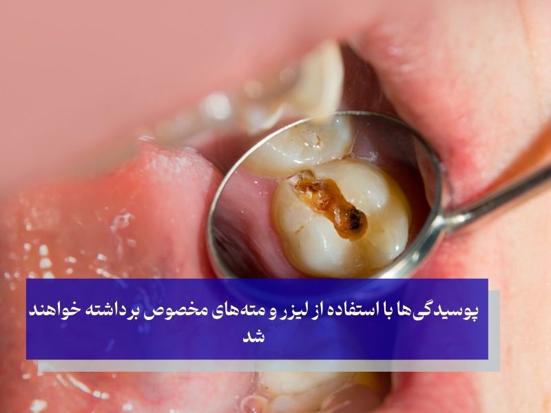 نحوه پر کردن دندان