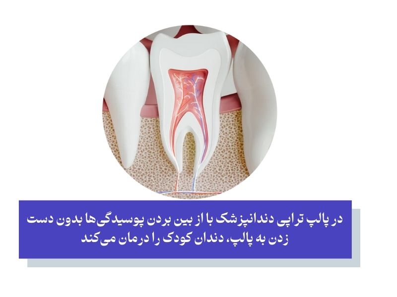 پالپ تراپی دندان کودکان