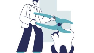 کشیدن دندان عقل بدون جراحی