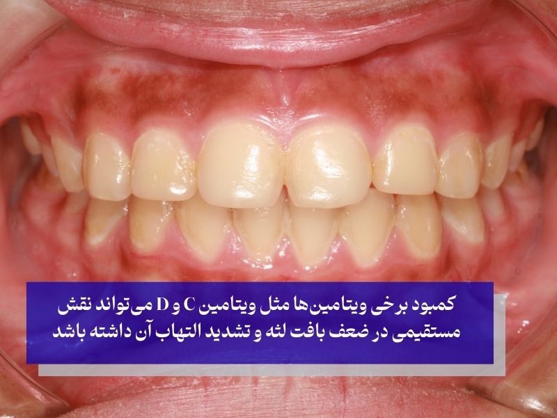 کمبود برخی ویتامین‌ها مثل ویتامین C و D می‌تواند نقش مستقیمی در ضعف بافت لثه و تشدید التهاب آن داشته باشد