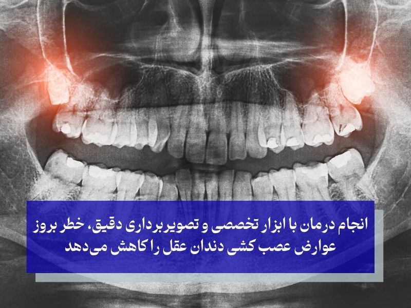 انجام درمان با ابزار تخصصی و تصویربرداری دقیق، خطر بروز عوارض عصب کشی دندان عقل را کاهش میدهد