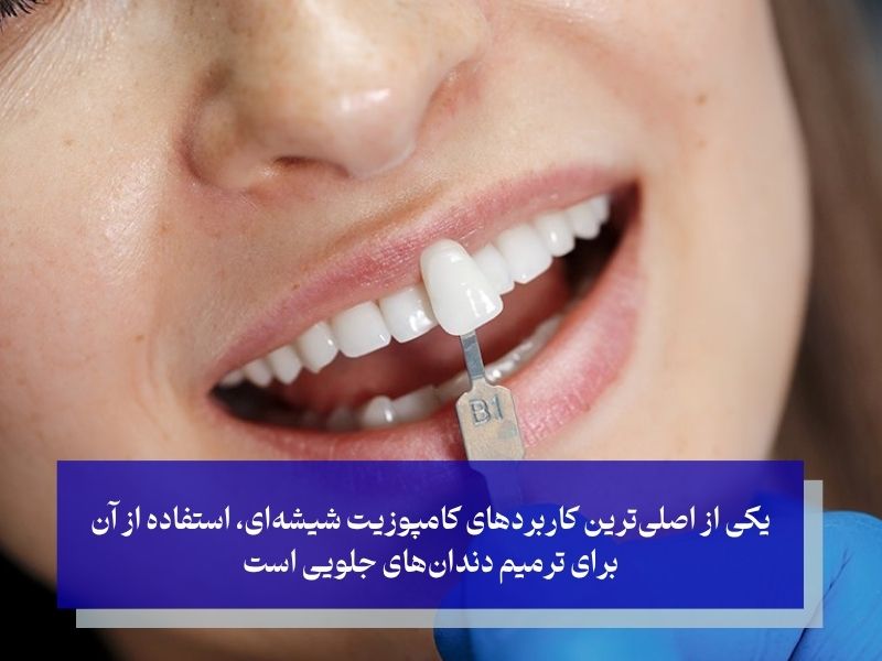 یکی از اصلیترین کاربردهای کامپوزیت شیشهای، استفاده از آن برای ترمیم دندانهای جلویی است