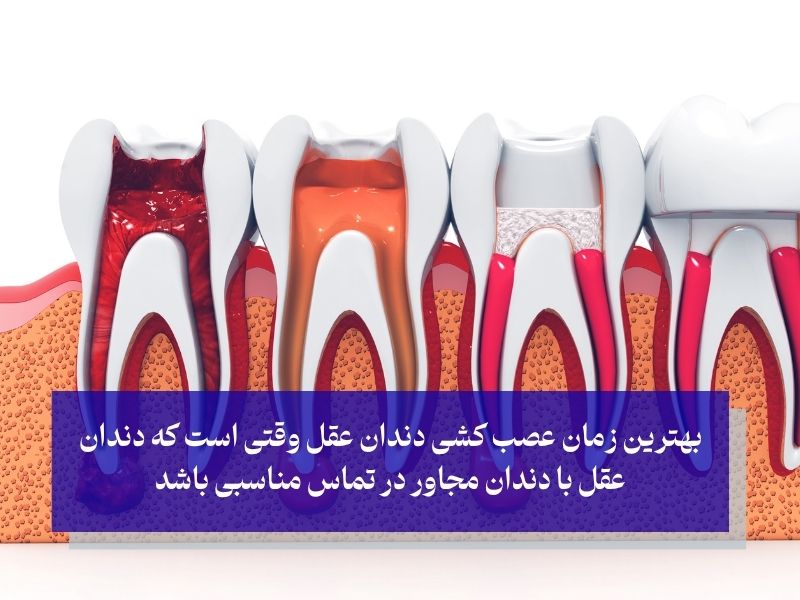 بهترین زمان عصب کشی دندان عقل وقتی است که دندان عقل با دندان مجاور در تماس مناسبی باشد