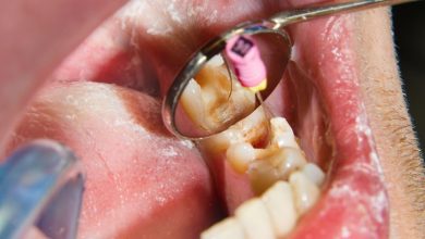 عصب ‌کشی دندان عقل