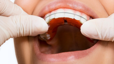 ارتودنسی فانکشنال