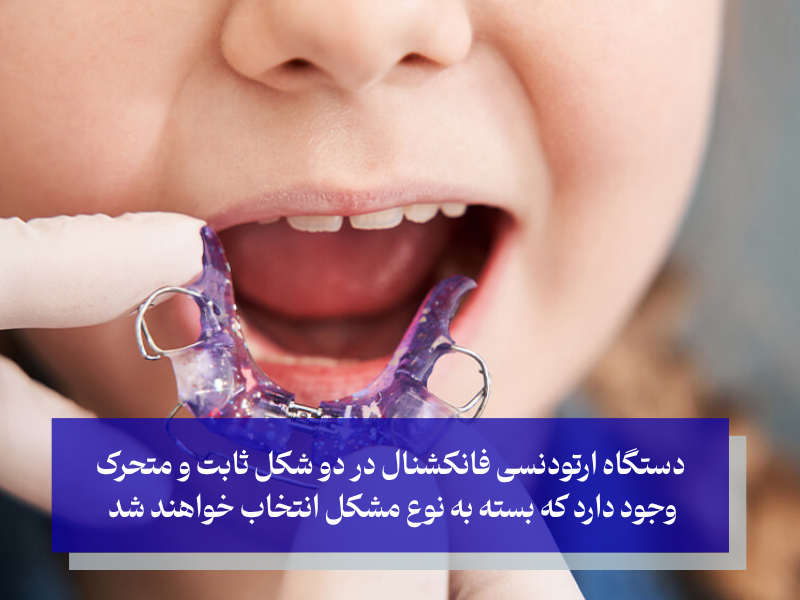 انواع دستگاه فانکشنال ارتودنسی