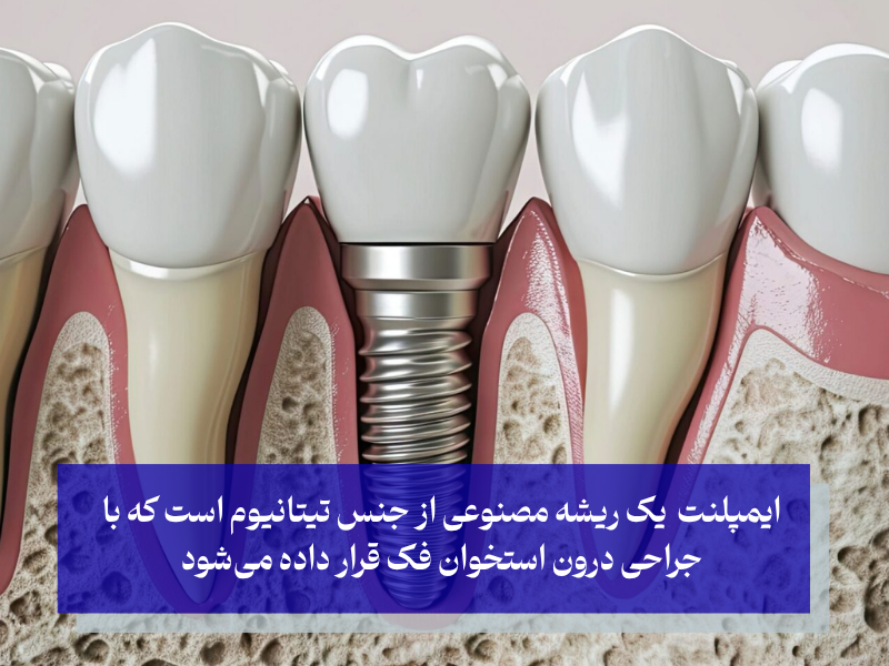 ایمپلنت دندانی چیست