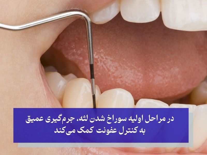 درمان سوراخ شدن لثه