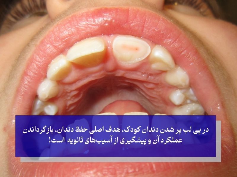 درمان لب‌ پر شدن دندان کودک؛ از ترمیم تا نجات ریشه