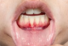سوراخ شدن لثه