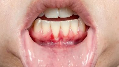 سوراخ شدن لثه