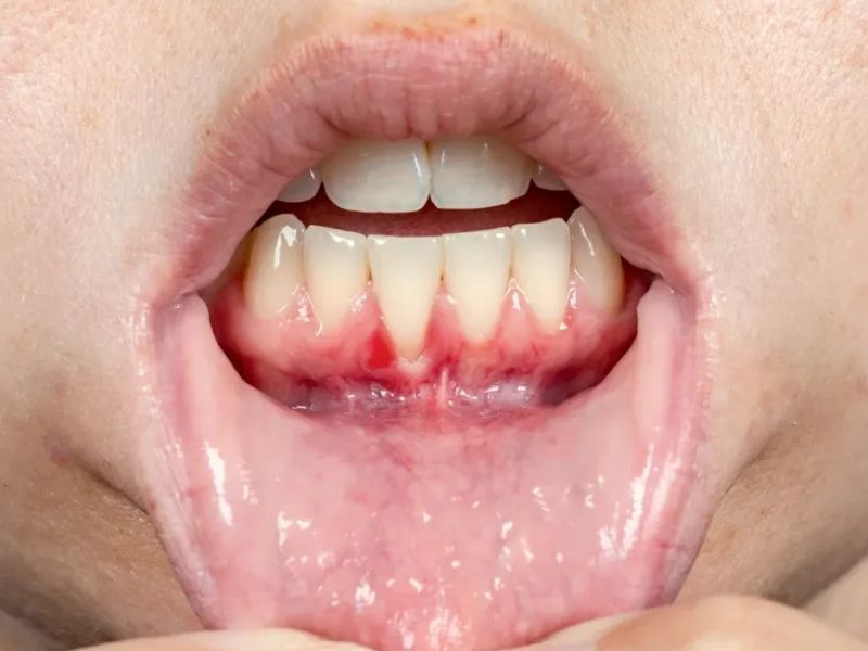 سوراخ شدن لثه