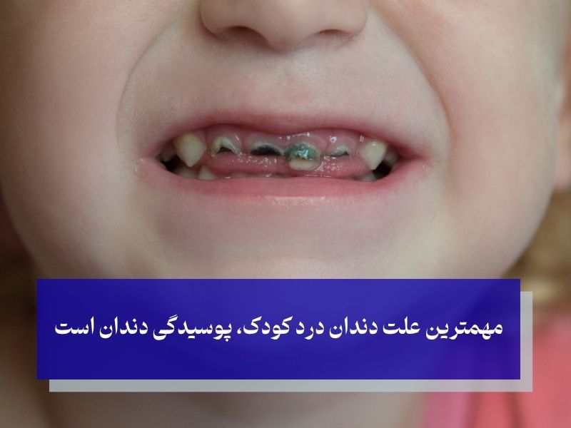 علت دندان درد کودک