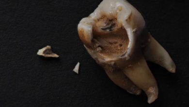 عوارض نکشیدن دندان خراب