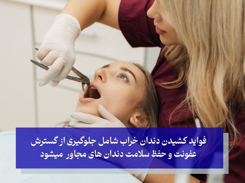 فواید کشیدن دندان خراب